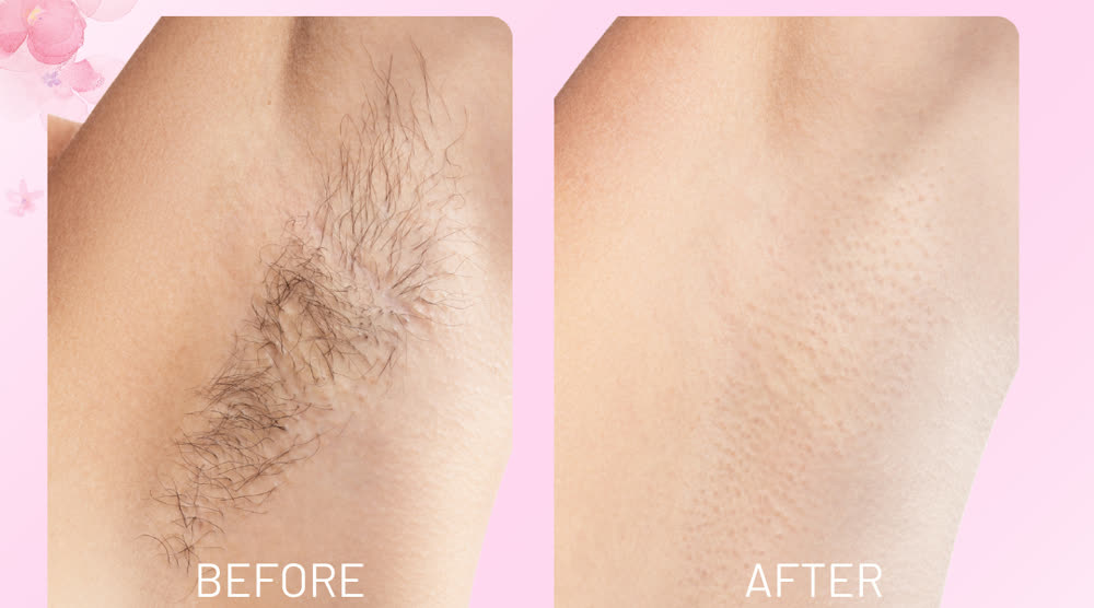 Before and after — underarm