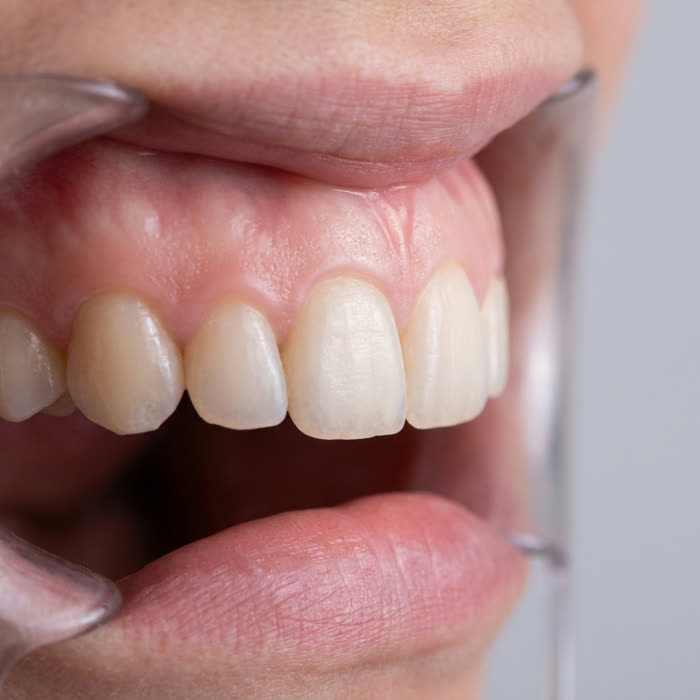 Week two — calmer, pinker gums